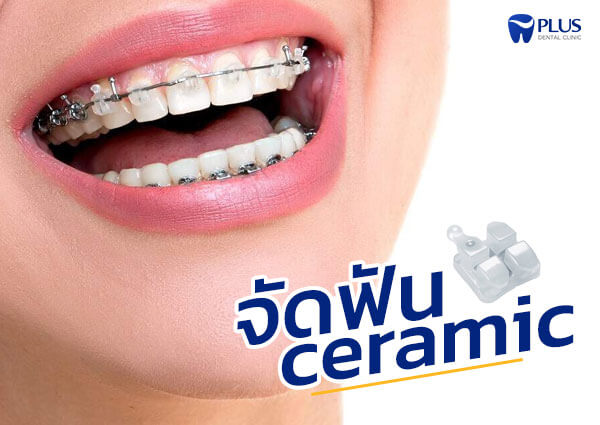 จัดฟันแบบเซรามิก (Ceramic Braces)